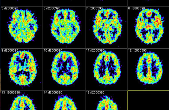 Air Pollution Exposure May Increase Risk Of Dementia